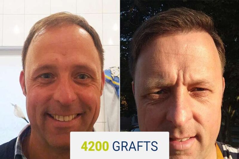 After hair transplant — 4200 grafts