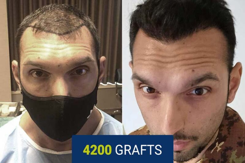 After hair transplant — 4200 grafts